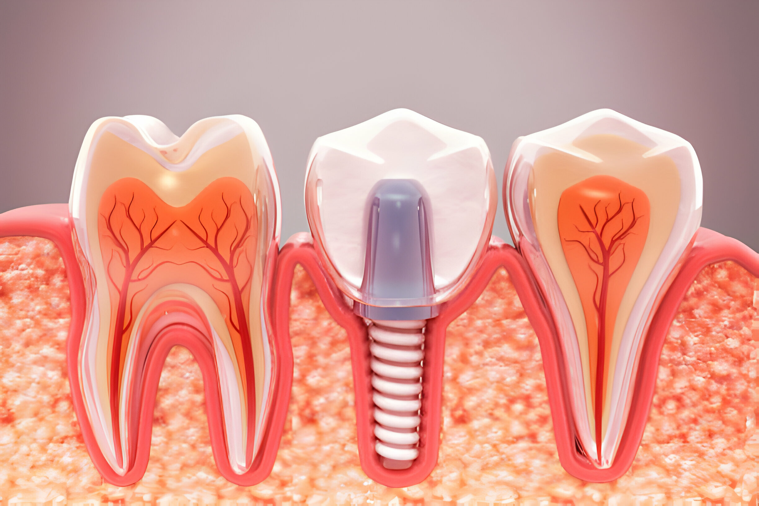 What to Expect During Dental Implants in Frisco, TX_1