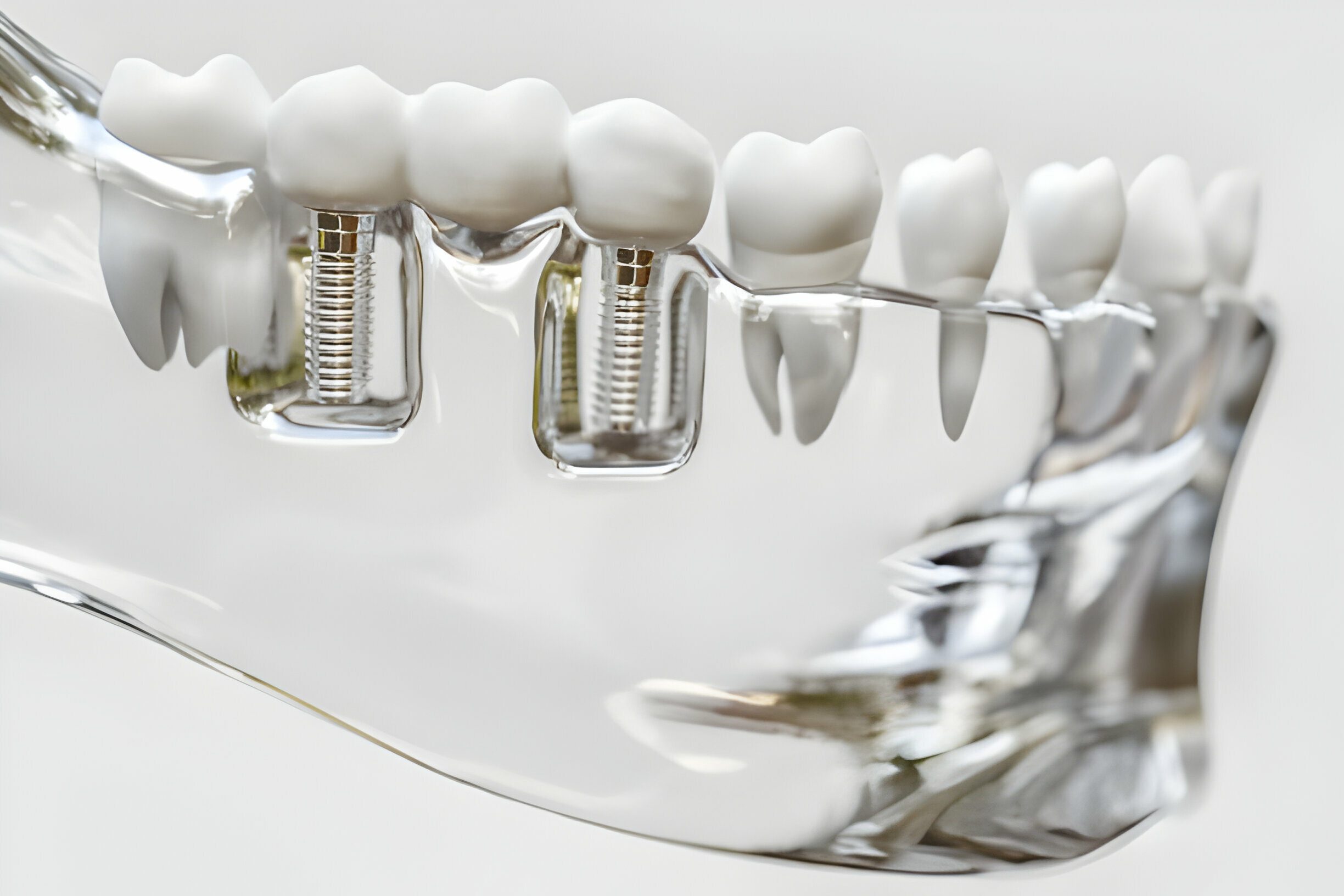 What to Expect During Dental Implants in Frisco, TX_3