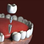 What to Expect During Dental Implants in Frisco, TX_FI