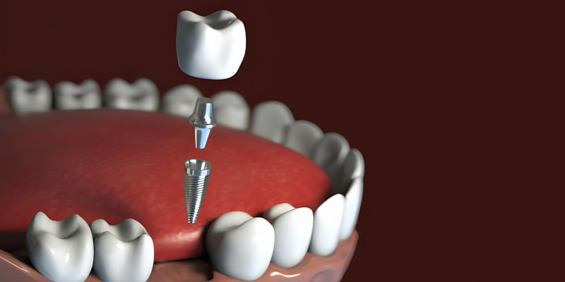 What to Expect During Dental Implants in Frisco, TX_FI