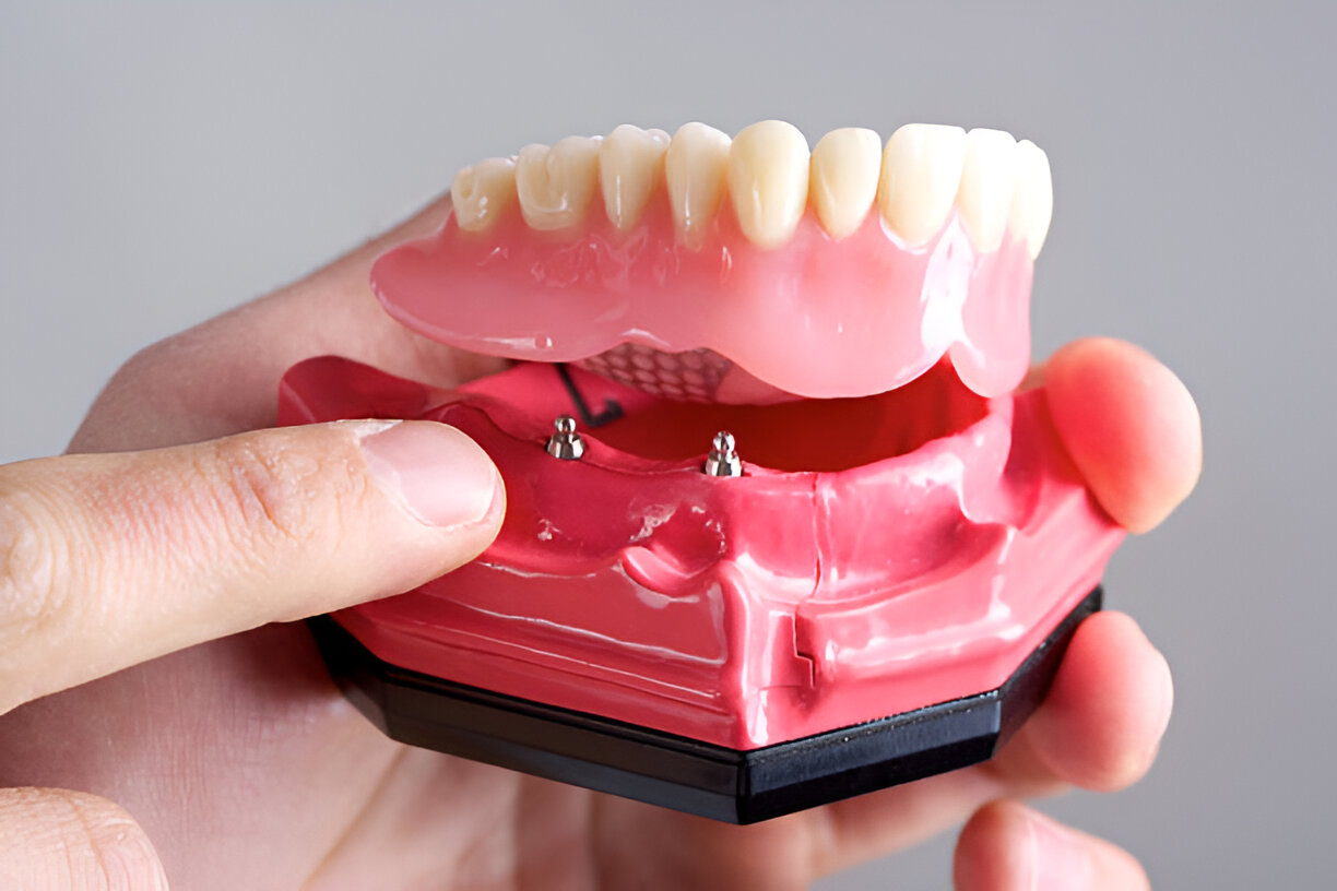 Dental Arts of Frisco: Providing the Best Dentures Experience in Frisco, TX_3