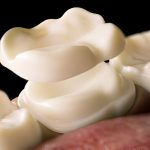 Explore Dental Sealants in Frisco, TX: Recommendations from the Best Dentist at Dental Arts of Frisco_FI